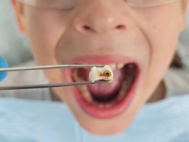 Best Broken Tooth Emergency  in Pella, IA